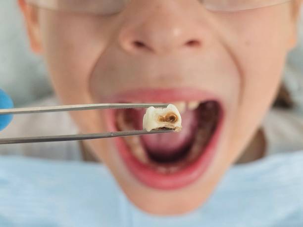 Best Dental Abscess Treatment in Rkesburg, PA